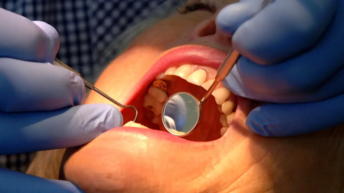 nottingham universitesinden dis minesini yenileyen yeni jel gelistirildi Al8RhRFv.jpg